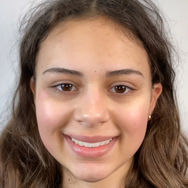 Angel-na-orthodontie-behandeling