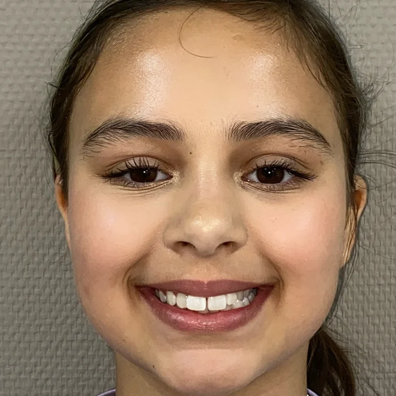 Angel-voor-orthodontie-behandeling