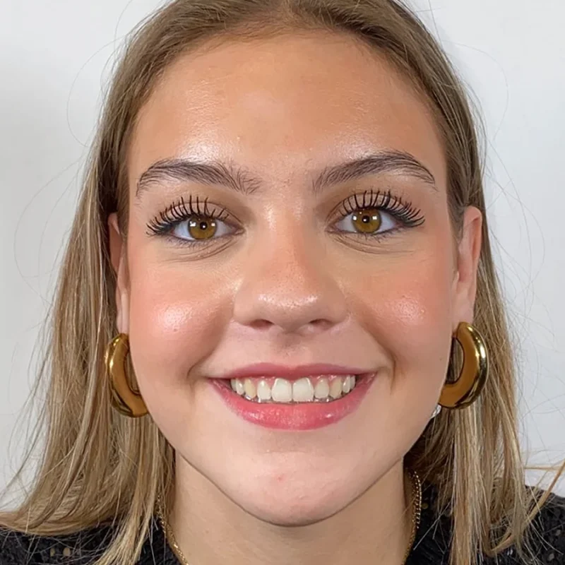 Ashley-na-orthodontie-behandeling