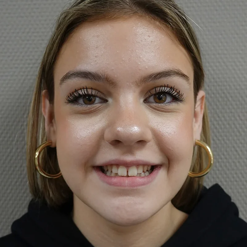 Ashley-voor-orthodontie-behandeling