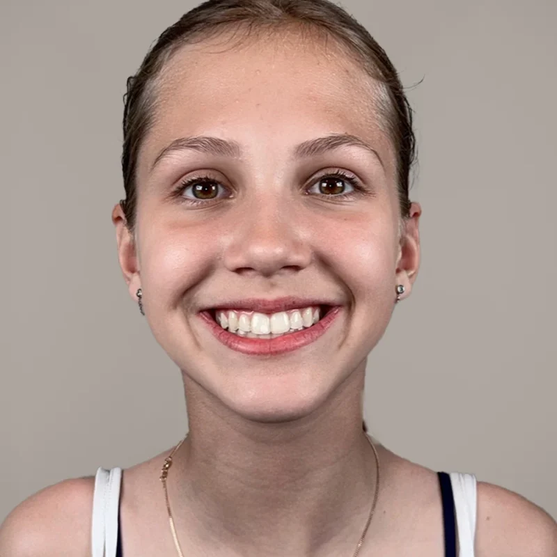 Blix-na-orthodontie-behandeling-resultaat