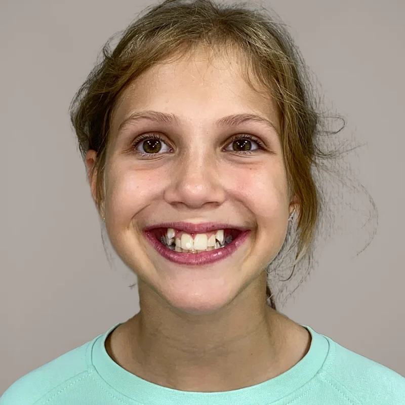 Blix-voor-orthodontie-behandeling-resultaat