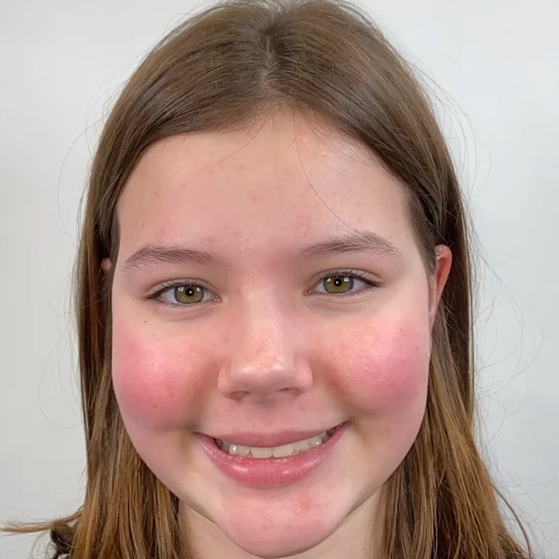 Jasmijn-voor-orthodontie-behandeling