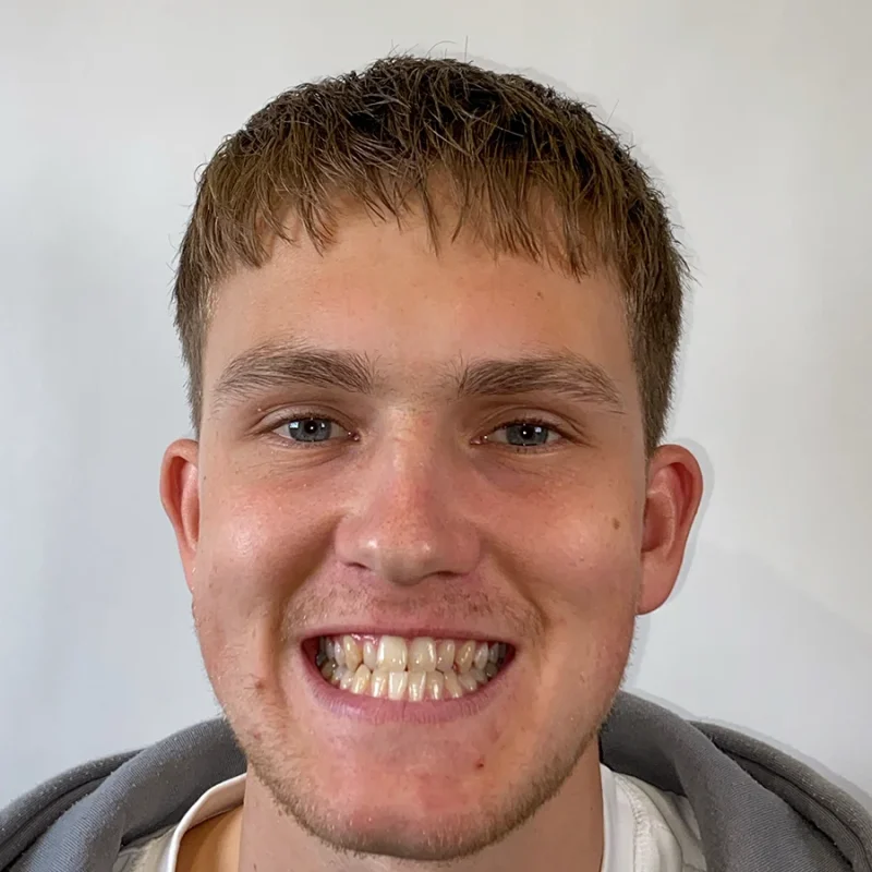 Jorn-voor-orthodontie-behandeling
