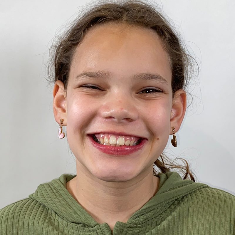 Orthodontie-beugelresultaat-na-behandeling-voor-Jalissa