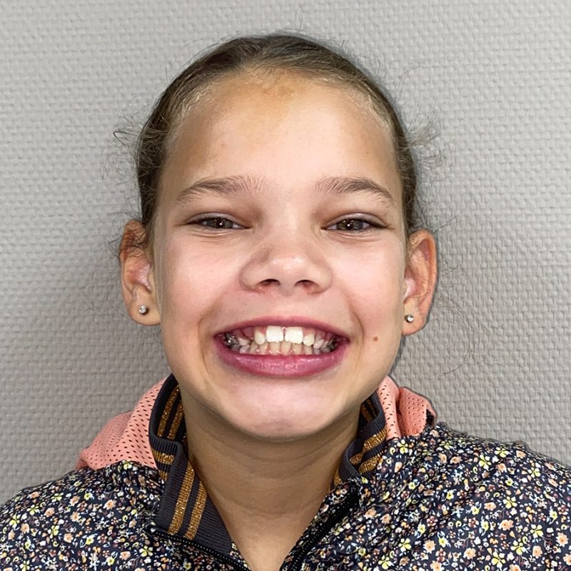 Orthodontie-beugelresultaat-voor-behandeling-voor-Jalissa