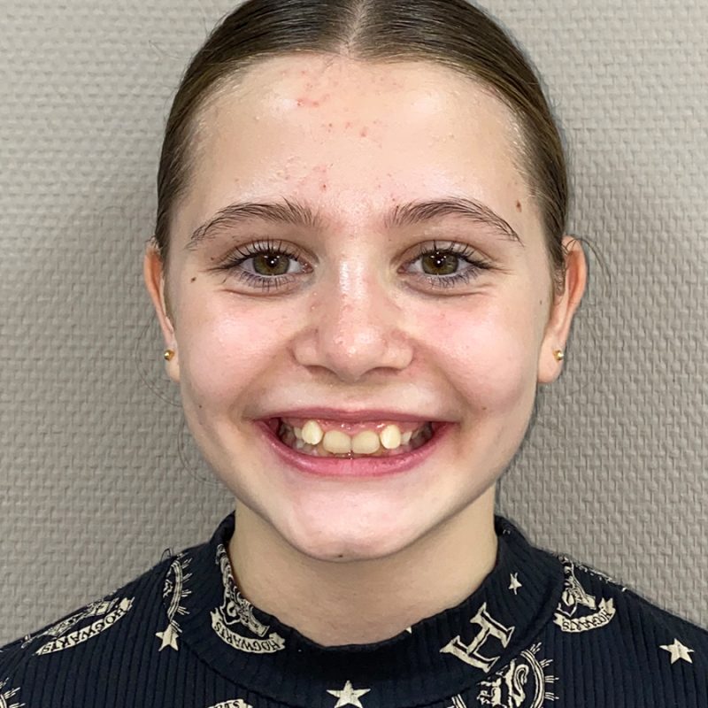 Orthodontie-beugelresultaat-voor-behandeling-voor-Sole