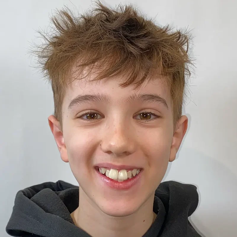Xavi-vooraanzicht-voor-orthodontie-behandeling